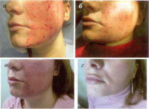 stages of skin recovery after fractional ablation procedure