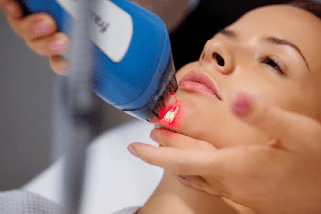 laser rejuvenation of the facial skin