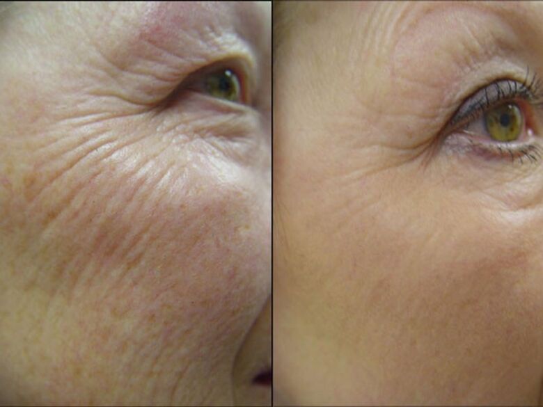 Before and after the laser rejuvenation procedure - a significant reduction of wrinkles