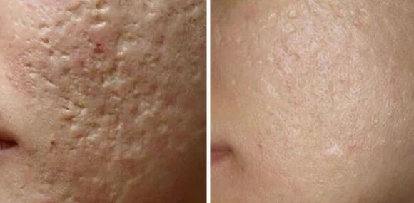 Laser grinding of scars
