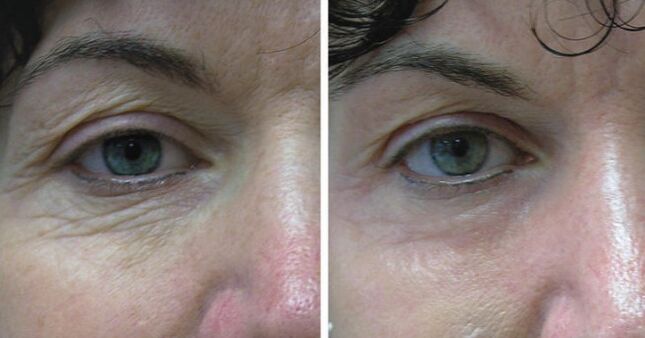 Skin lases around the eyes